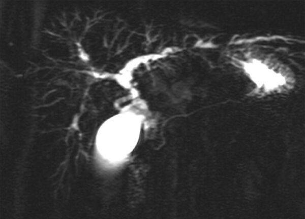 Factores de riesgo para colangitis esclerosante primaria