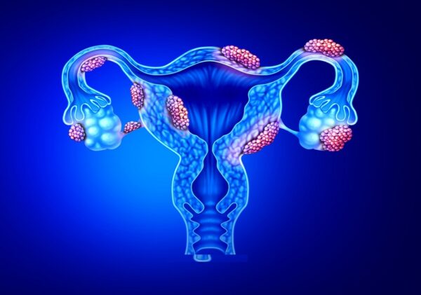 Endometriosis