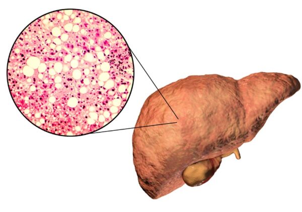 ¿Qué es la hepatopatía grasa no alcohólica?