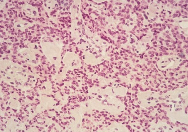 ¿Qué es un gastrinoma?