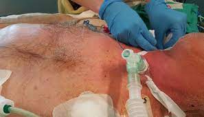 Indicaciones para una vía aérea quirúrgica