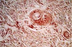 Clasificación de la amiloidosis