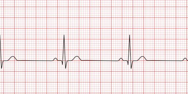 Causas comunes de bradicardia