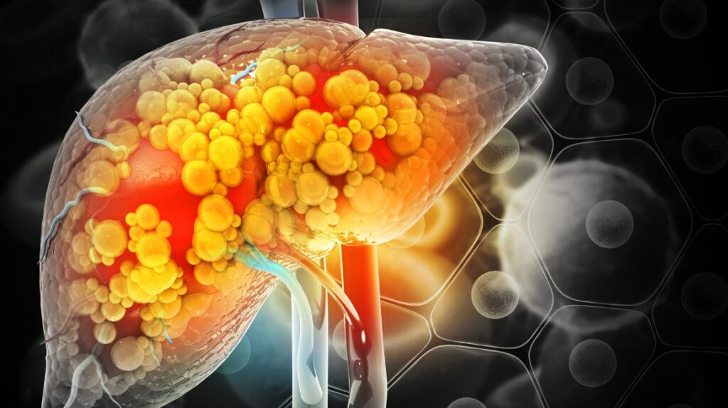 ¿Es reversible la esteatosis hepática por alcoholismo?