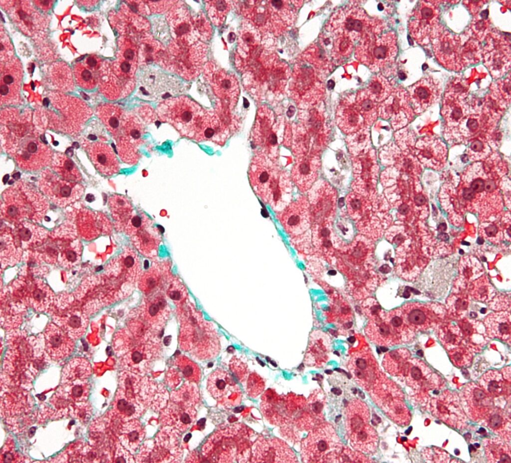 Lesión del hepatocito mediada por el acetaldehído