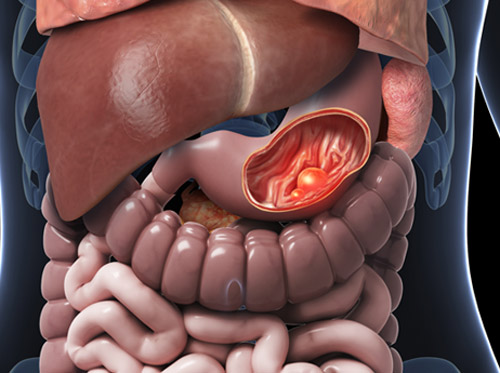 ¿Qué son los tumores carcinoides?