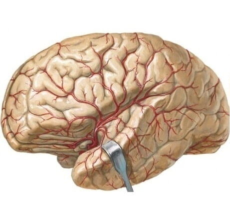 Manifestaciones de la embolia de la arteria cerebral media