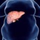 Factores de riesgo para hepatopatía grasa no alcohólica