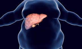 Factores de riesgo para hepatopatía grasa no alcohólica