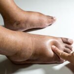 Causas de edema agudo o crónico de las extremidades