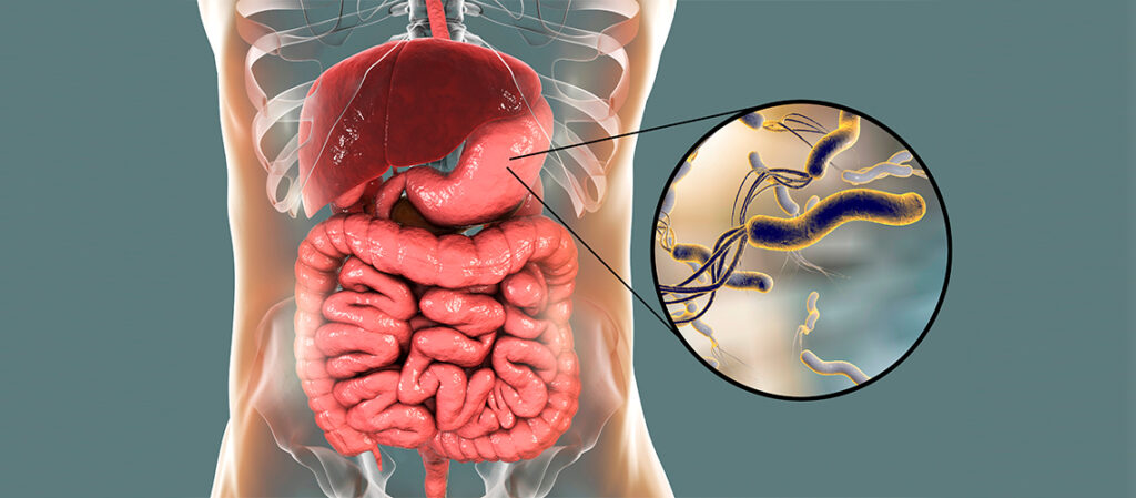 Helicobacter pylori es factor clave en la enfermedad ácido péptica