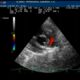 ¿Cuál es el estudio diagnóstico más preciso para la estenosis de la válvula pulmonar?