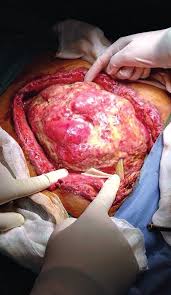 ¿Qué es el abdomen hostil?