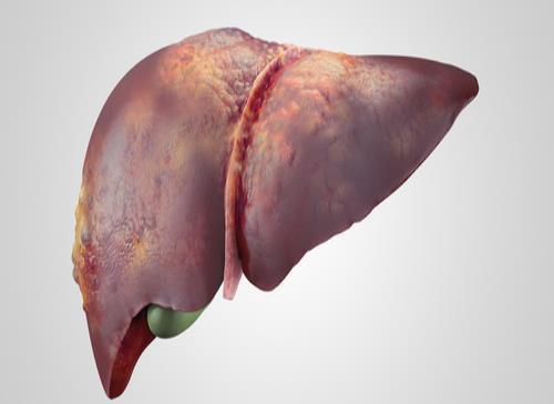 Fibrosis, precursor de la cirrosis hepática