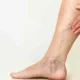 ¿Por qué los síntomas vasculares son tan variados?