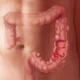 ¿Que es la diverticulosis?