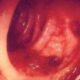 Hemorragia diverticular