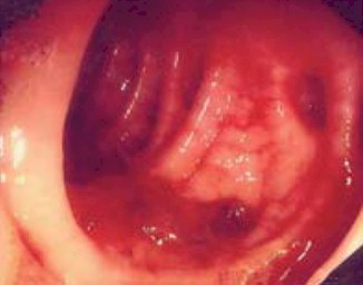 Hemorragia diverticular, alternativas de manejo