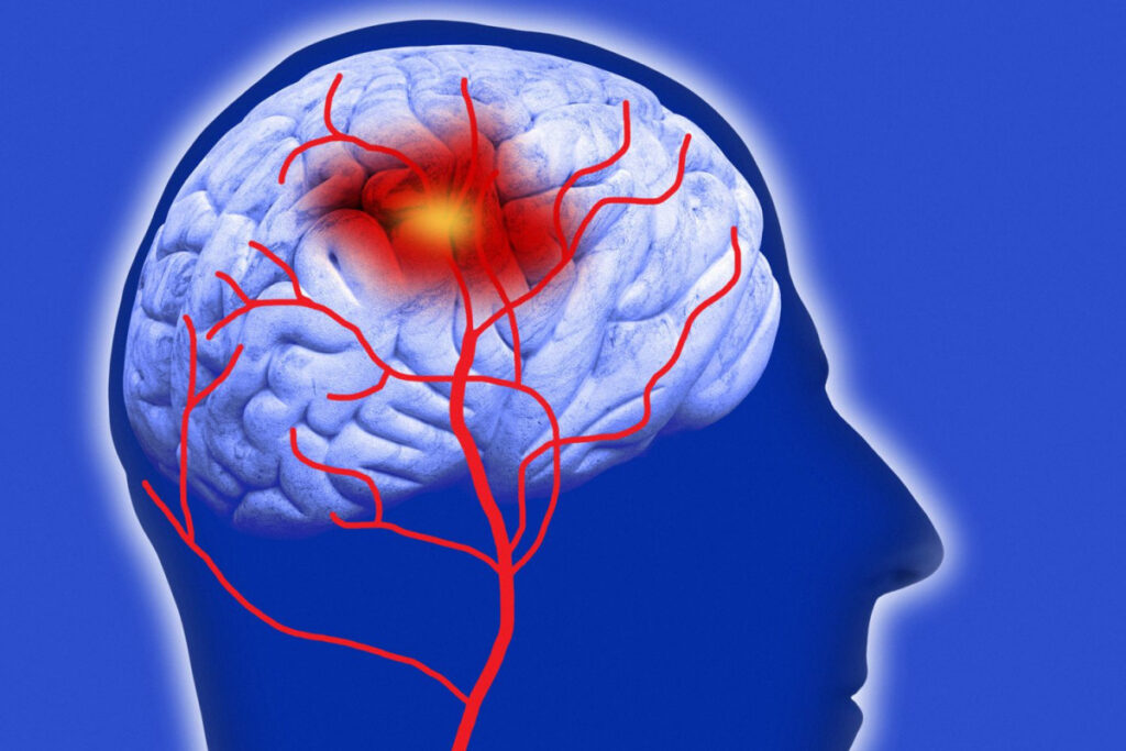 Escala Cincinnati para Accidente Cerebrovascular