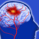 Escala Cincinnati para Accidente Cerebrovascular