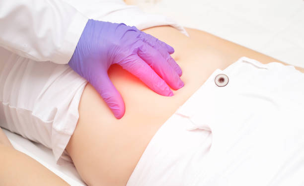 irritación peritoneal