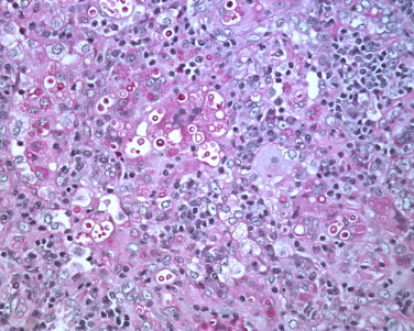 Reacciones de ácido peryódico-reactivo de Schif