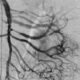 Angiografia de urgencia en hemorragia digestiva