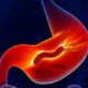 Relación entre las úlceras gástricas y duodenales con H. pylori
