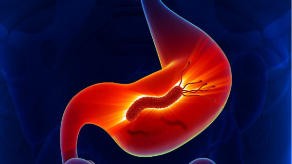 Relación entre las úlceras gástricas y duodenales con H. pylori