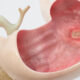 Ulceras gástricas y duodenales causadas por fármacos