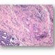 Histopatología de la inflamación idiopática de la órbita