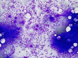 ¿Qué es la trombocitemia?