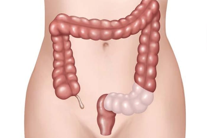 Indicación de cirugía en diverticulitis no complicada