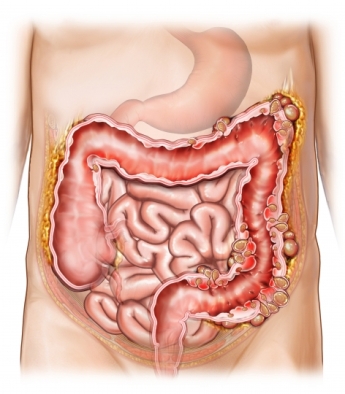 Manifestaciones de diverticulitis complicada