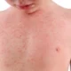 Anamnesis en el paciente con fiebre y exantema