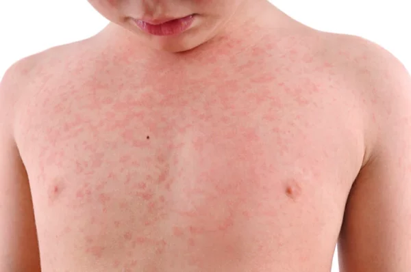 Anamnesis en el paciente con fiebre y exantema