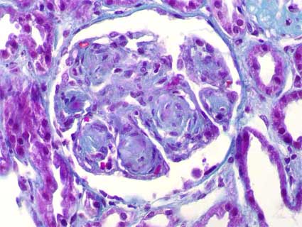 Agregados extracelulares de la amiloidosis