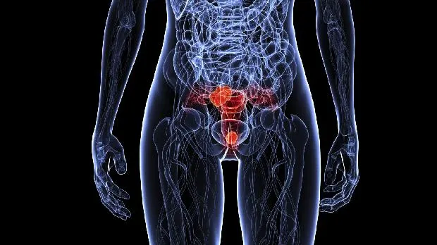 Causas de sangrado uterino anormal en premenopáusicas