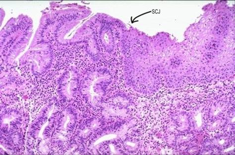 Unión escamocolumnar del cuello uterino