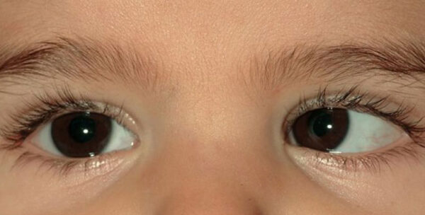 Movimientos extraoculares anormales