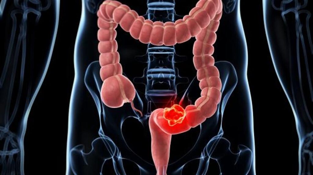 Opciones para detección de cáncer colorrectal