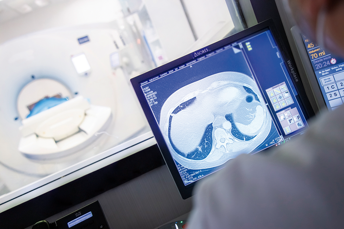 Detección de cáncer pulmonar en pacientes fumadores
