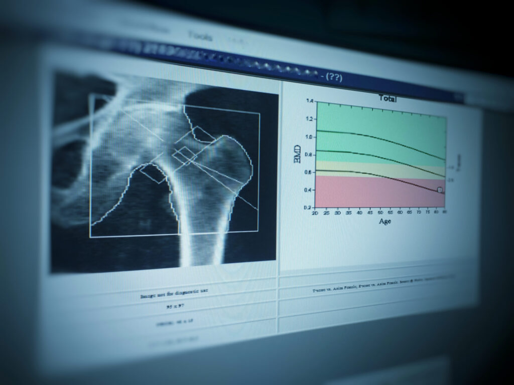 ¿A quíenes se recomienda la detección de osteoporosis?