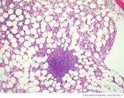 Manifestaciones clinicas de anemia aplásica