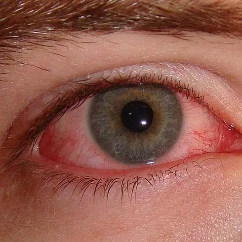 Conjuntivitis alérgica estacional y perenne