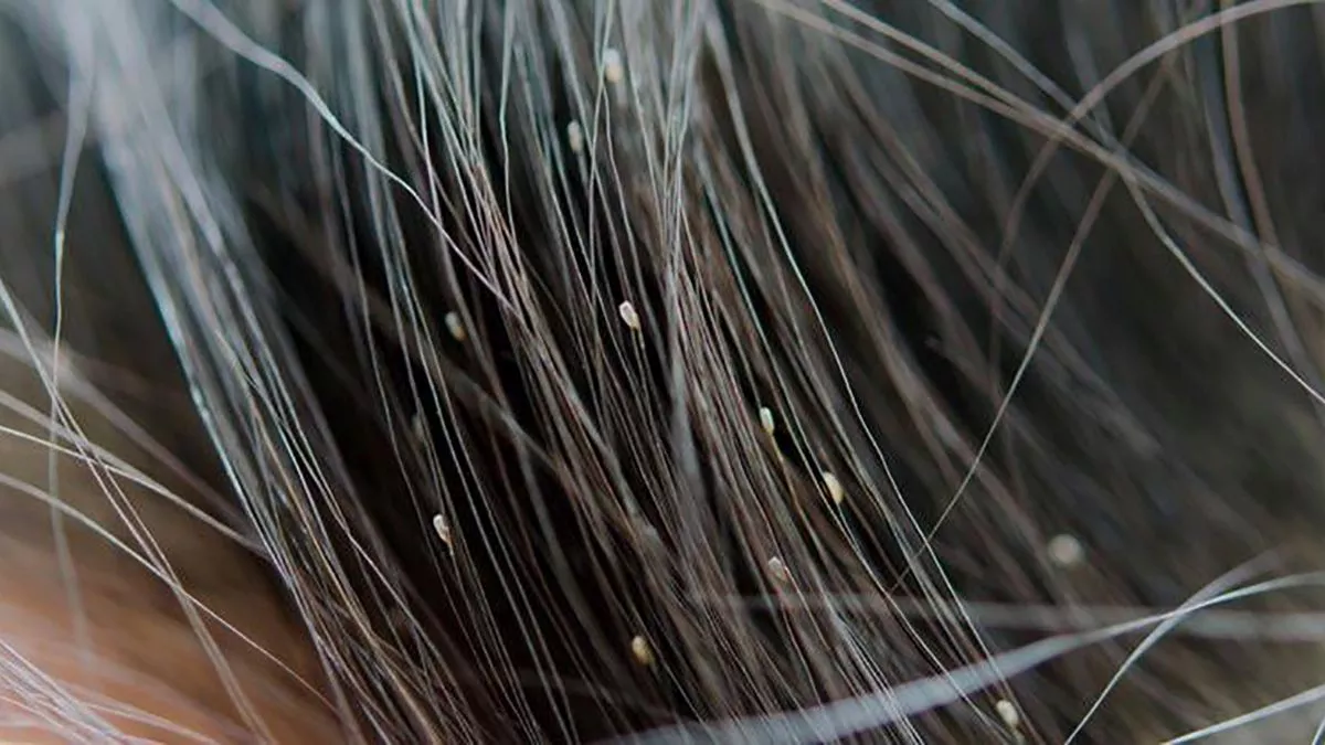 ¿Qué es la pediculosis?