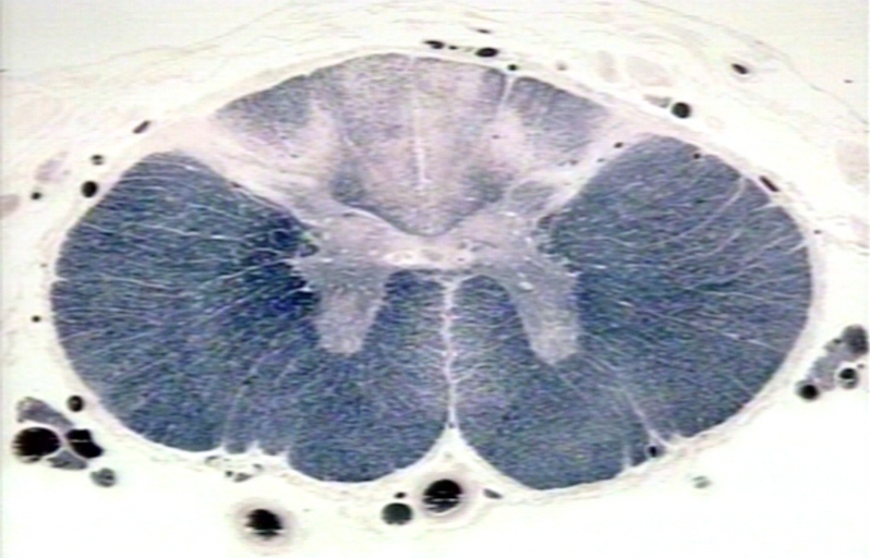 ¿Qué es Tabes dorsal?