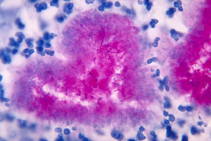 ¿Qué causa la nocardiosis?