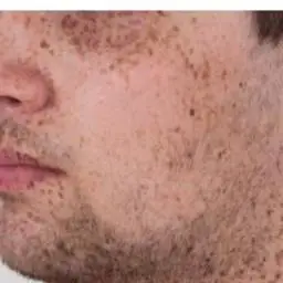 Complejo de Carney: Stratakis C. A. (2016). Carney complex: A familial lentiginosis predisposing to a variety of tumors. Reviews in endocrine & metabolic disorders, 17(3), 367–371. https://doi.org/10.1007/s11154-016-9400-1