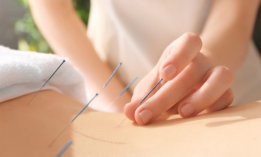 Beneficios reales de la acupuntura para la salud